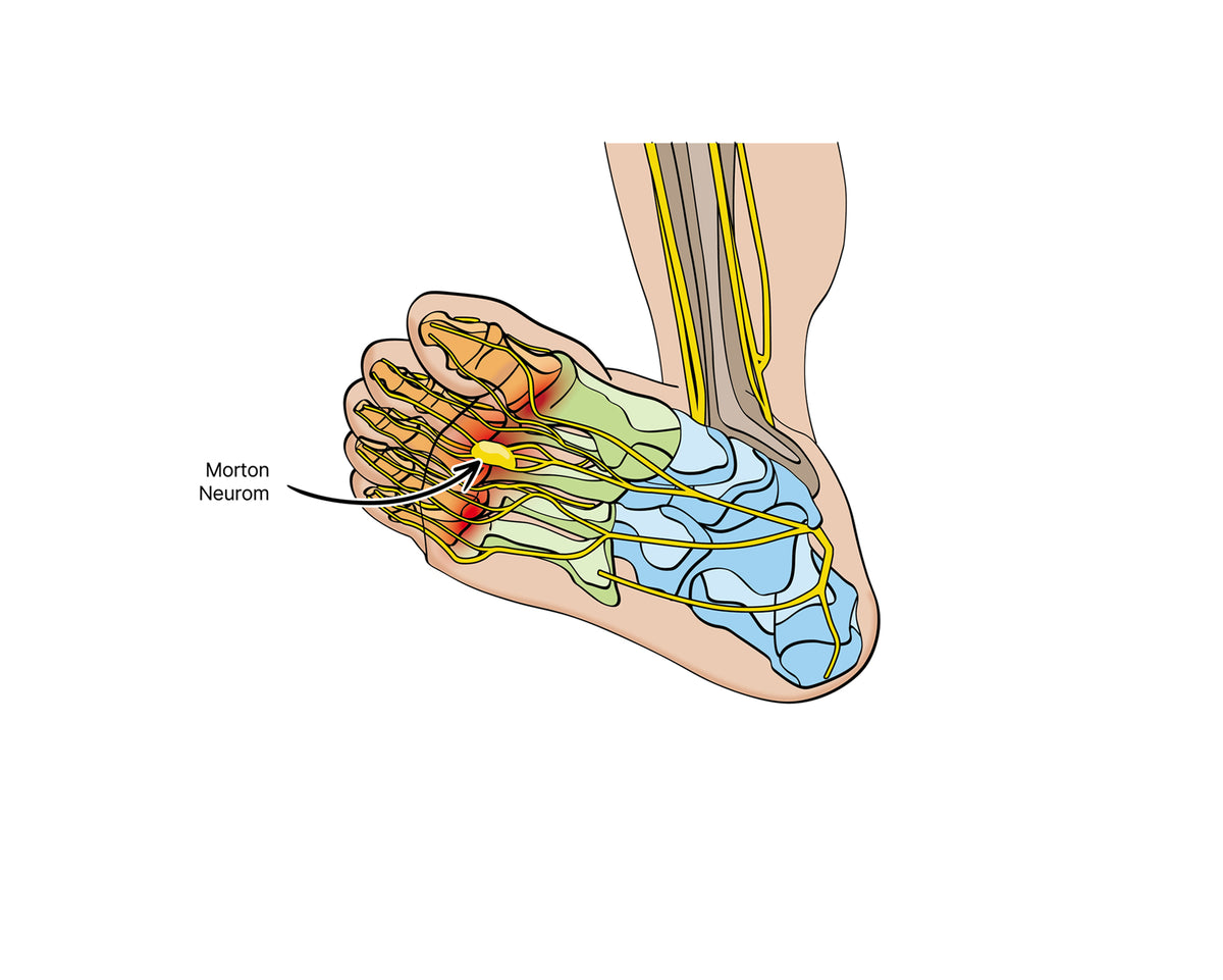 Morton Neurom